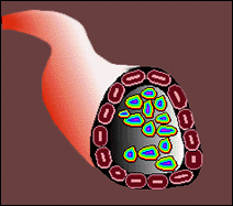 close up of cancer cells in duct