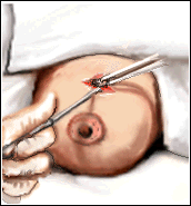 what is removed in a lumpectomy