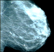 pic of a Mammogram
